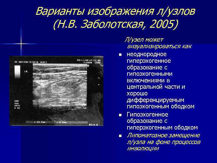 Варианты изображения л/узлов (Н. В. Заболотская, 2005) Л/узел может визуализироваться как n n n