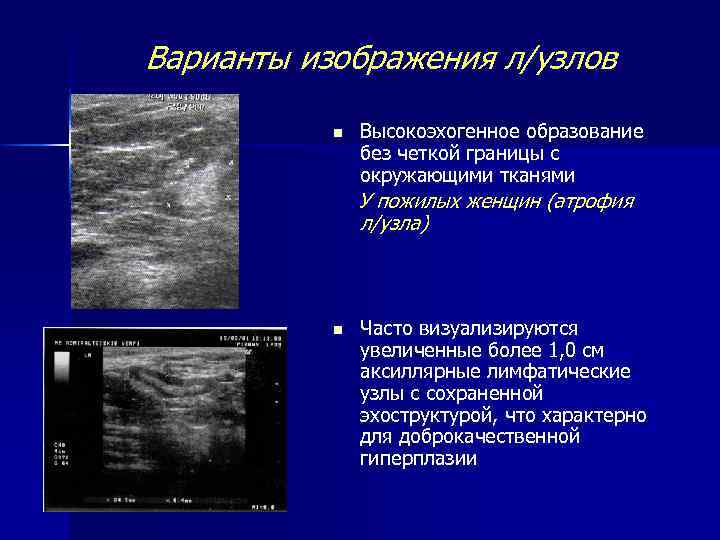 Варианты изображения л/узлов n Высокоэхогенное образование без четкой границы с окружающими тканями У пожилых