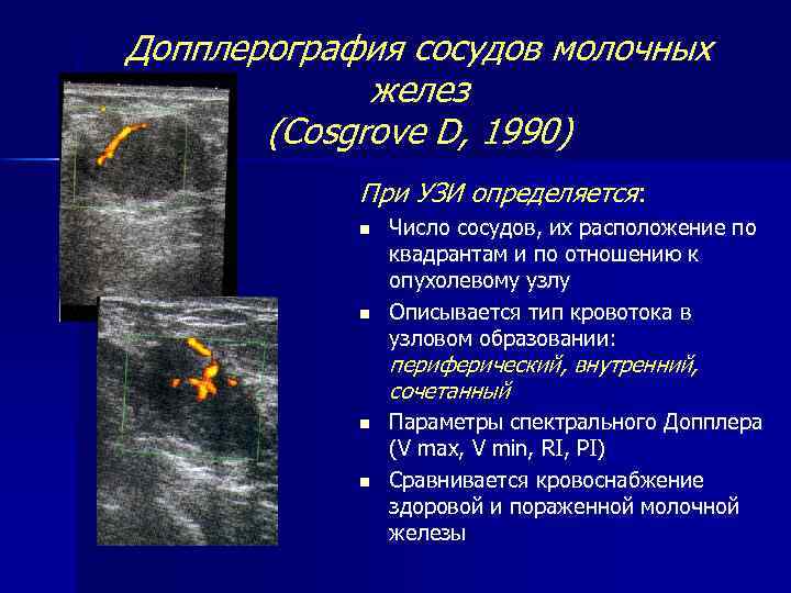 Допплерография сосудов молочных желез (Cosgrove D, 1990) При УЗИ определяется: n n Число сосудов,