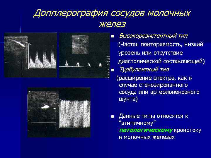 Допплерография сосудов молочных желез n Высокорезистентный тип (Частая повторяемость, низкий уровень или отсутствие диастолической