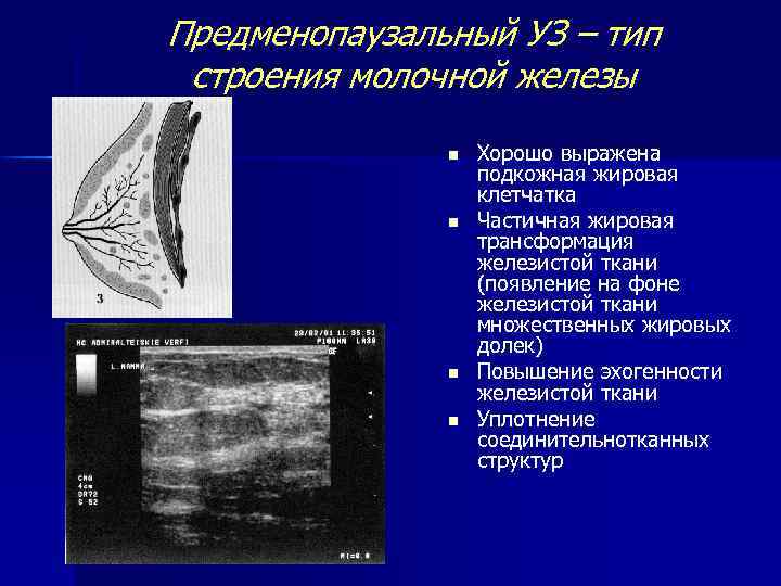 Предменопаузальный УЗ – тип строения молочной железы n n Хорошо выражена подкожная жировая клетчатка