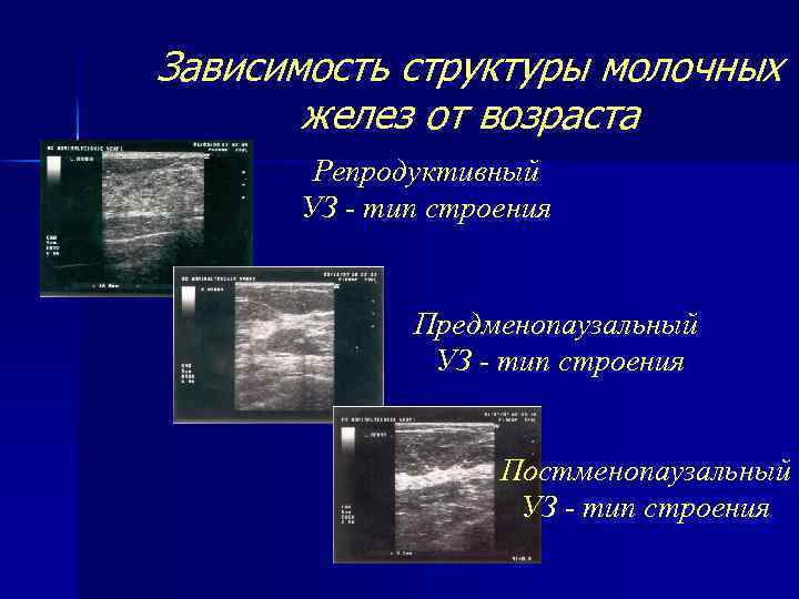 Зависимость структуры молочных желез от возраста Репродуктивный УЗ - тип строения Предменопаузальный УЗ -