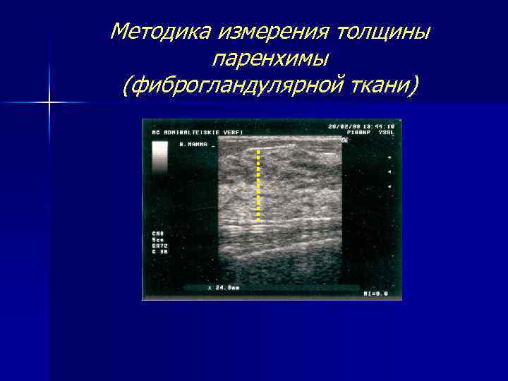 Методика измерения толщины паренхимы (фиброгландулярной ткани) 