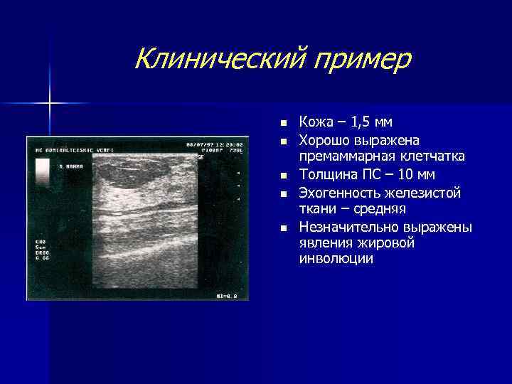 Клинический пример n n n Кожа – 1, 5 мм Хорошо выражена премаммарная клетчатка