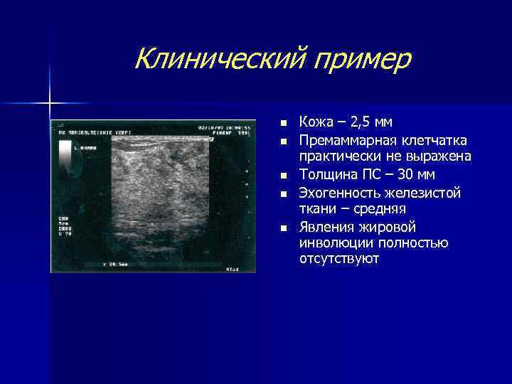 Клинический пример n n n Кожа – 2, 5 мм Премаммарная клетчатка практически не