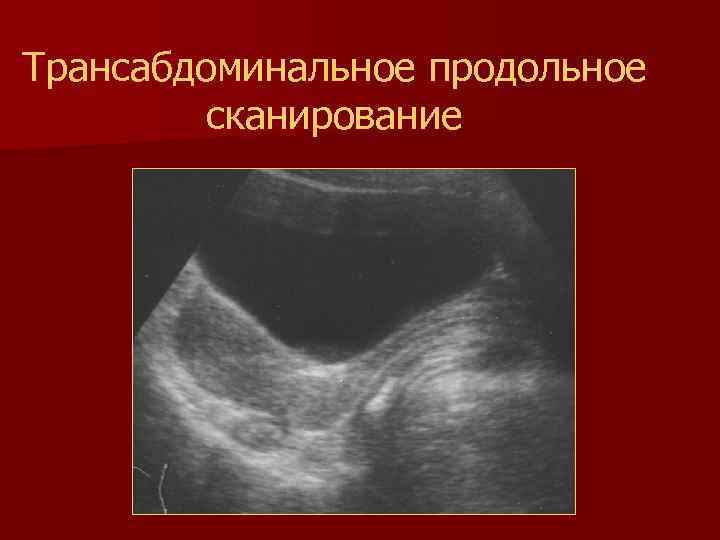 Трансабдоминальное продольное сканирование 