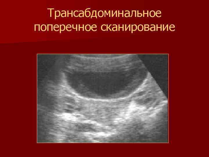 Трансабдоминальное поперечное сканирование 