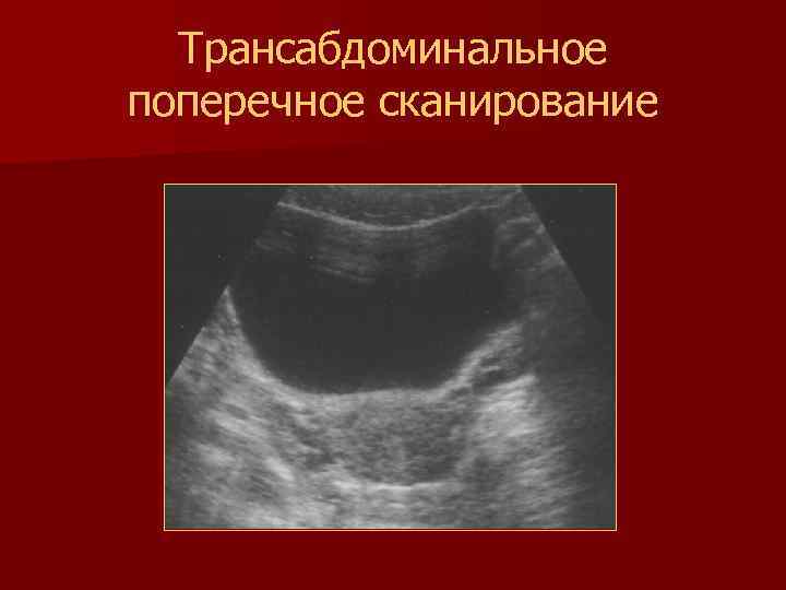 Трансабдоминальное поперечное сканирование 