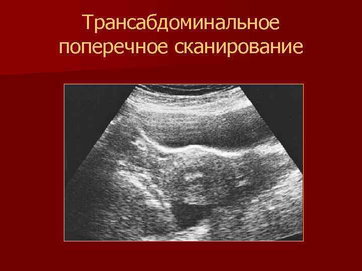 Трансабдоминальное поперечное сканирование 