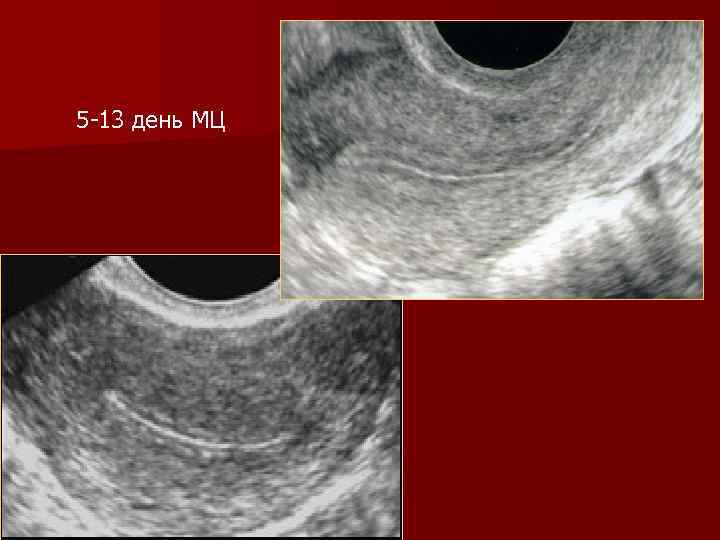 5 -13 день МЦ 