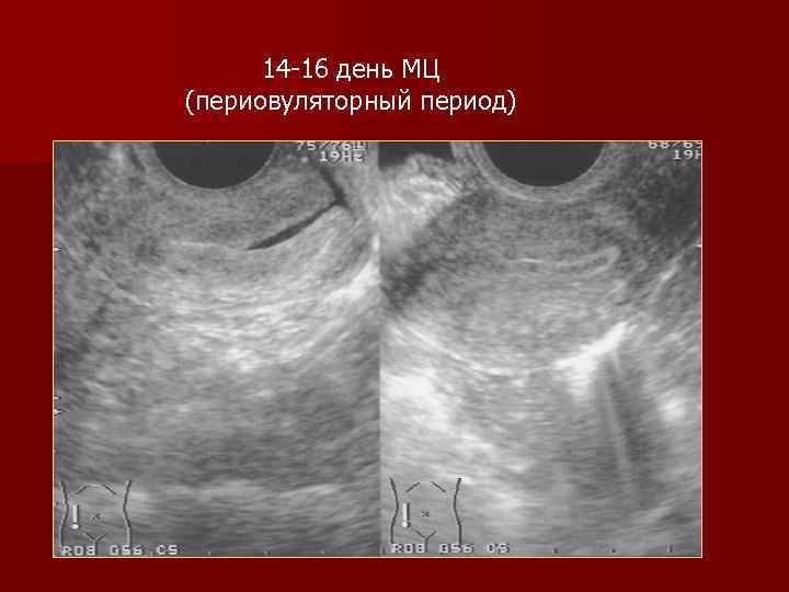 14 -16 день МЦ (периовуляторный период) 