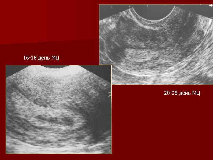 16 -18 день МЦ 20 -25 день МЦ 