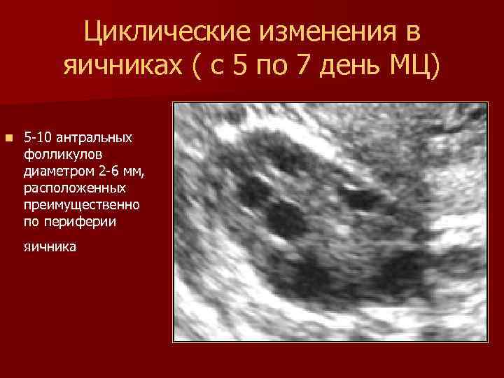 Циклические изменения в яичниках ( с 5 по 7 день МЦ) n 5 -10