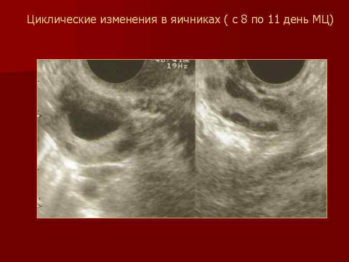 Циклические изменения в яичниках ( с 8 по 11 день МЦ) 