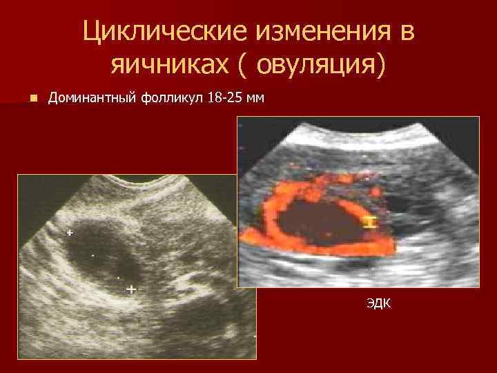 Циклические изменения в яичниках ( овуляция) n Доминантный фолликул 18 -25 мм ЭДК 