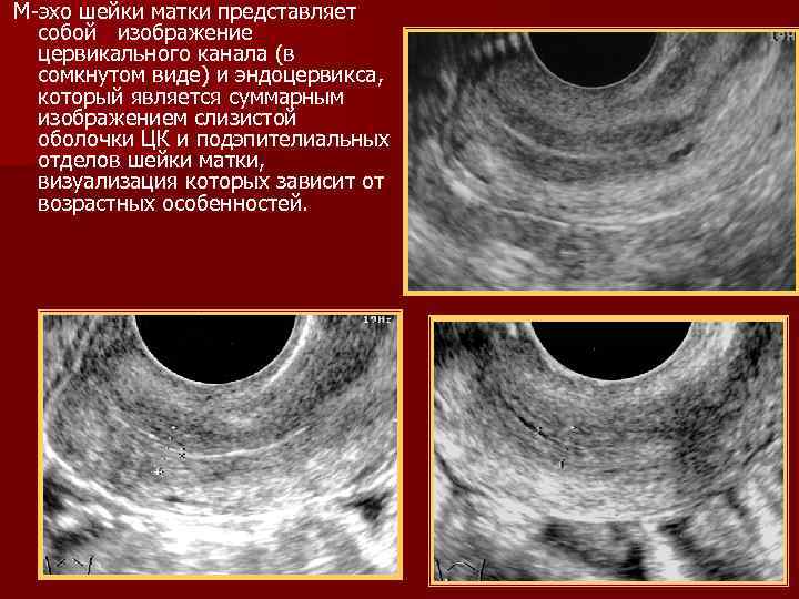 М-эхо шейки матки представляет собой изображение цервикального канала (в сомкнутом виде) и эндоцервикса, который