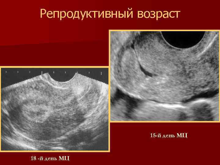 Репродуктивный возраст 15 -й день МЦ 18 -й день МЦ 