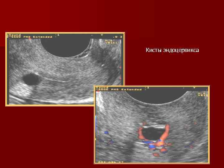 Кисты эндоцервикса 