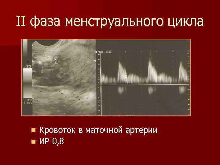 II фаза менструального цикла Кровоток в маточной артерии n ИР 0, 8 n 