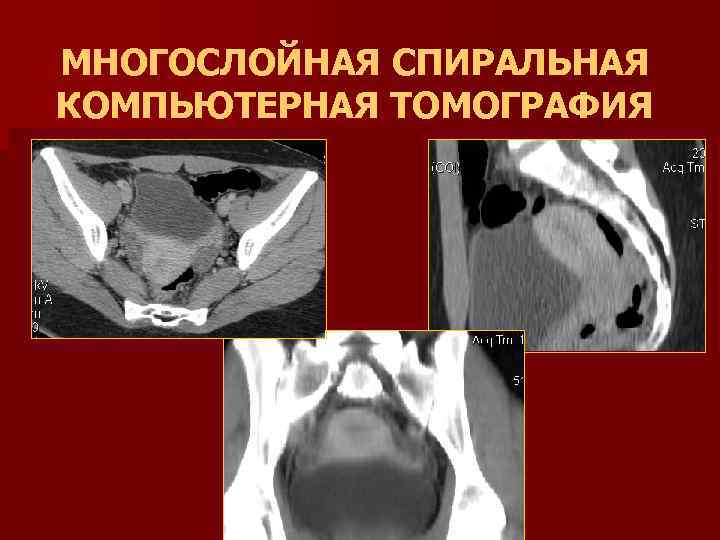 МНОГОСЛОЙНАЯ СПИРАЛЬНАЯ КОМПЬЮТЕРНАЯ ТОМОГРАФИЯ 