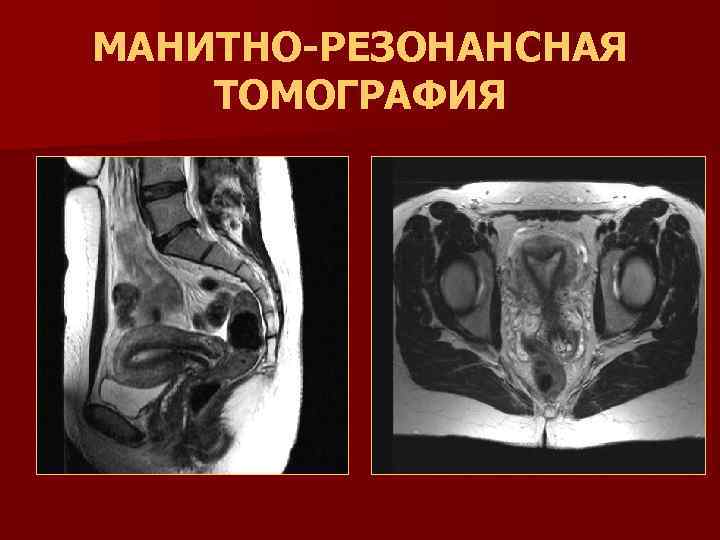 МАНИТНО-РЕЗОНАНСНАЯ ТОМОГРАФИЯ 