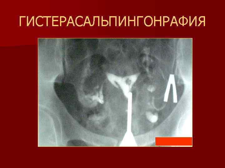 ГИСТЕРАСАЛЬПИНГОНРАФИЯ 