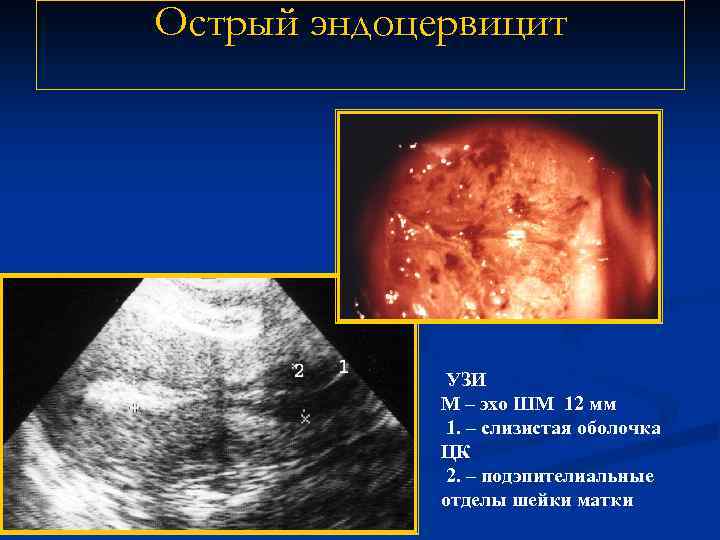 Острый эндоцервицит УЗИ М – эхо ШМ 12 мм 1. – слизистая оболочка ЦК