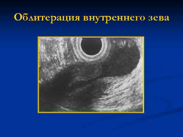 Облитерация внутреннего зева 