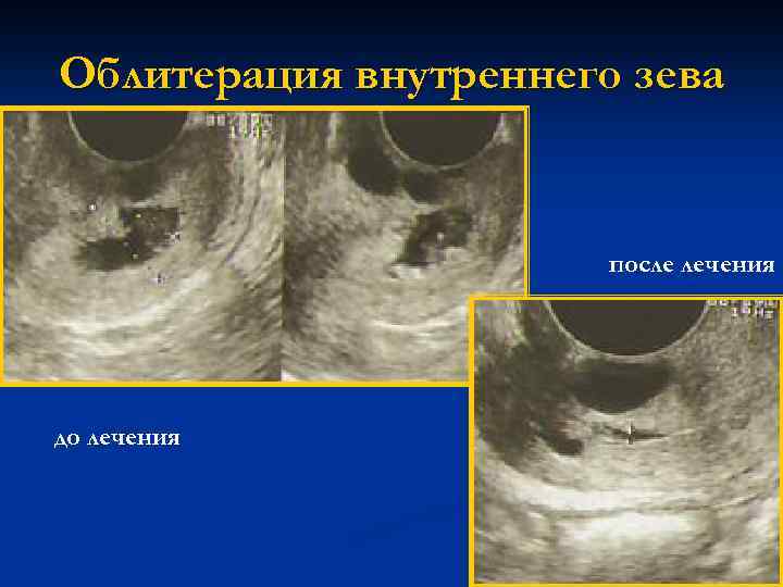 Внутренний зев. Облитерация внутреннего зева. Облитерация полости матки.