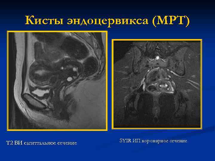 Кисты эндоцервикса (МРТ) Т 2 ВИ сагиттальное сечение SYIR ИП коронарное сечение 