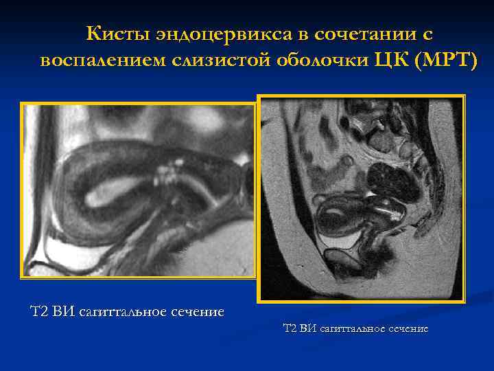 Киста эндоцервикса - признаки, причины, симптомы, лечение и профилактика - mountainline.ru