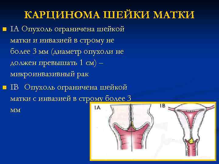 КАРЦИНОМА ШЕЙКИ МАТКИ n IА Опухоль ограничена шейкой матки и инвазией в строму не
