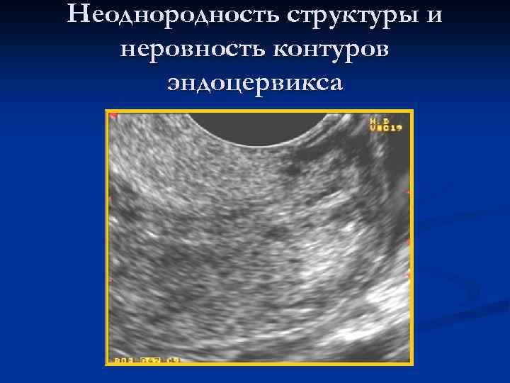 Кисты эндоцервикса. Структура эндоцервикса. Полипы эндоцервикса на УЗИ. Неоднородная структура эндоцервикса что это. Структурные изменения эндоцервикса.