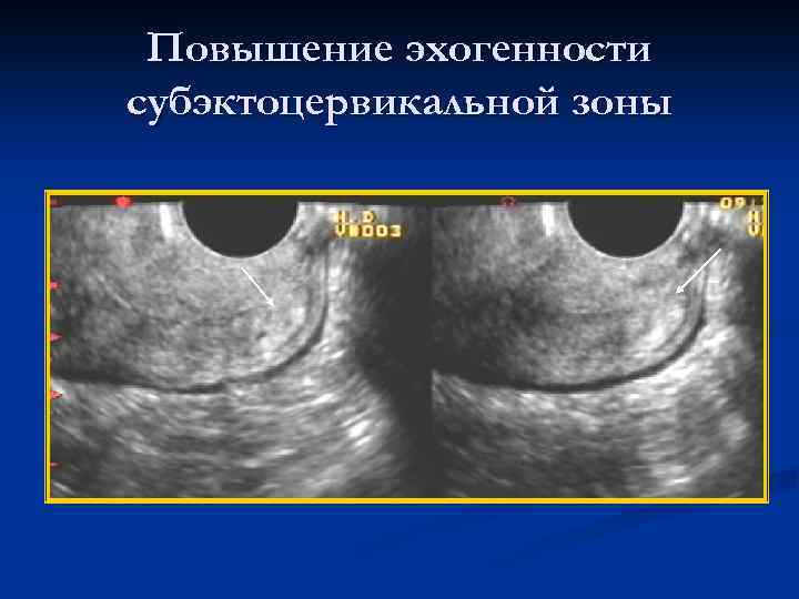 Повышение эхогенности субэктоцервикальной зоны 