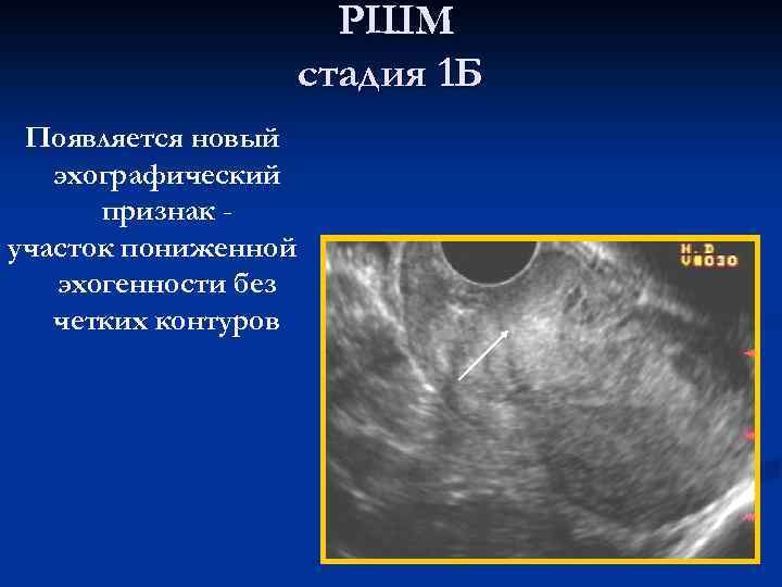 Эхографические признаки гиперплазии