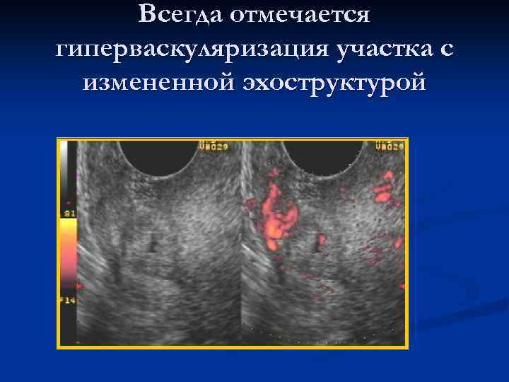 Всегда отмечается гиперваскуляризация участка с измененной эхоструктурой 