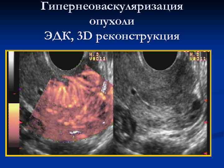 Гипернеоваскуляризация опухоли ЭДК, 3 D реконструкция 