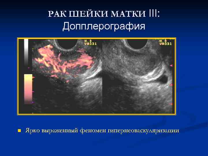 РАК ШЕЙКИ МАТКИ III: Допплерография n Ярко выраженный феномен гипернеоваскуляризации 