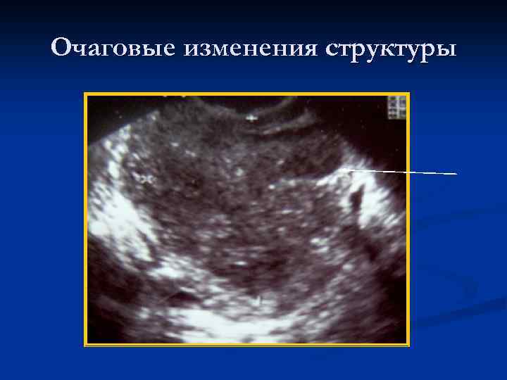 Очаговые изменения структуры 