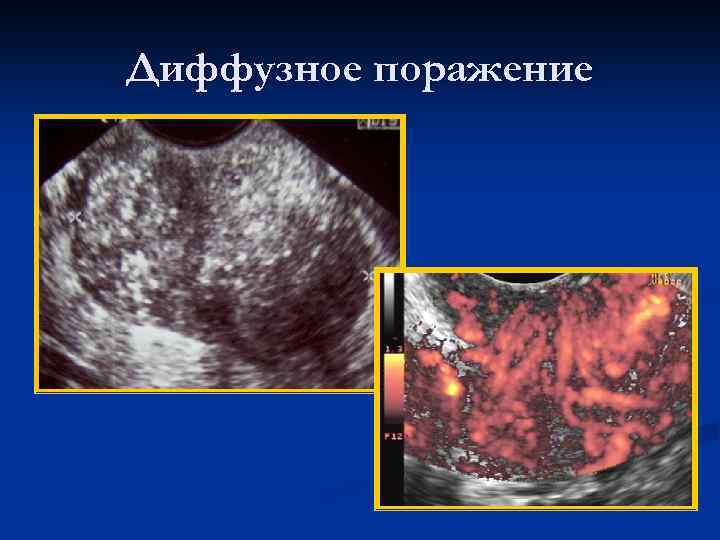 Диффузное поражение 
