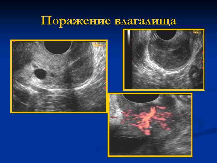 Поражение влагалища 