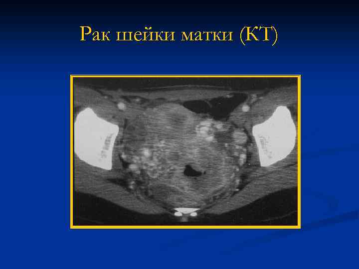 Рак шейки матки (КТ) 
