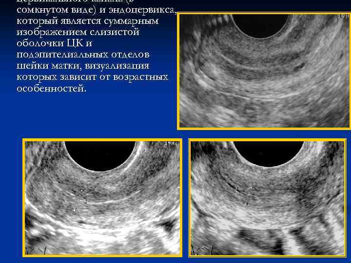Что такое кисты эндоцервикса на узи это фото