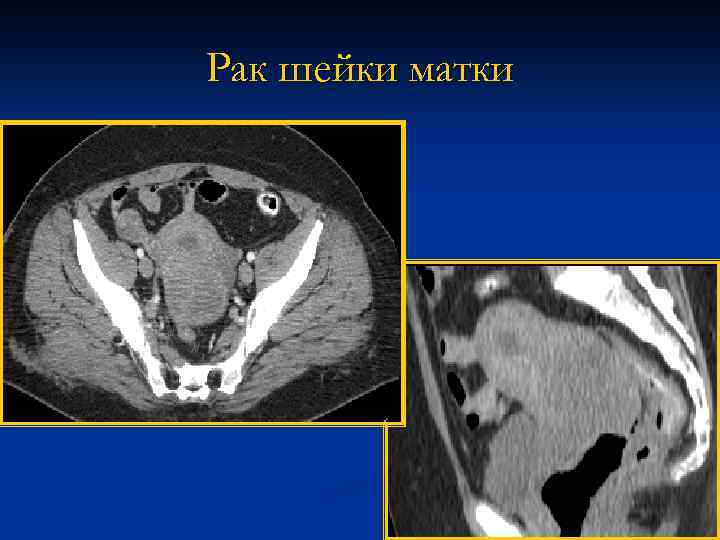 Рак шейки матки 