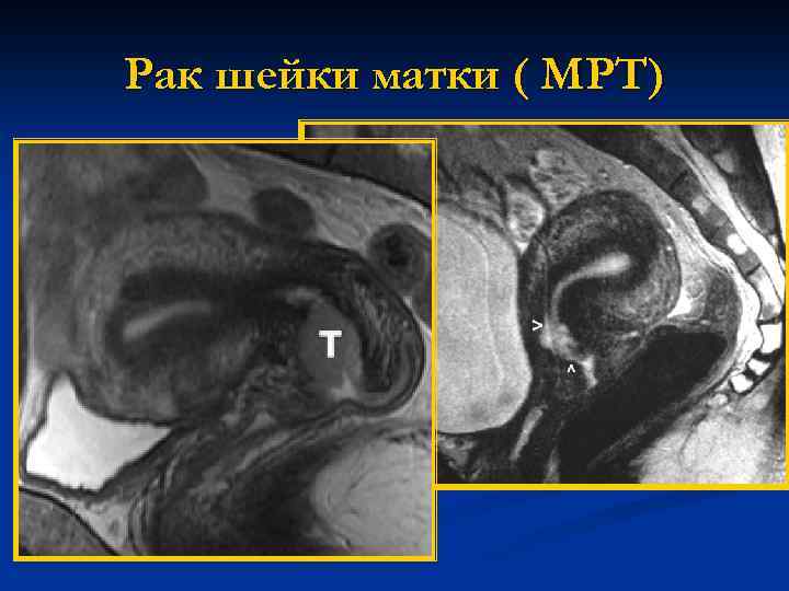 Рак шейки матки ( МРТ) 