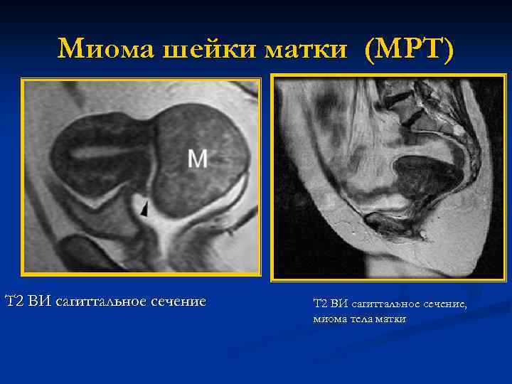 Как выглядит миома матки на мрт картинки