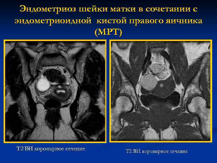 Эндометриоз шейки матки в сочетании с эндометриоидной кистой правого яичника (МРТ) Т 2 ВИ