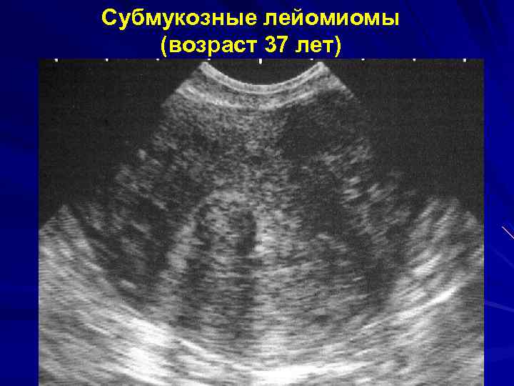 Субмукозные лейомиомы (возраст 37 лет) 