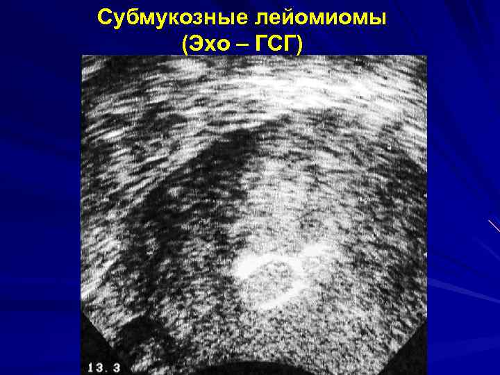 Субмукозные лейомиомы (Эхо – ГСГ) 