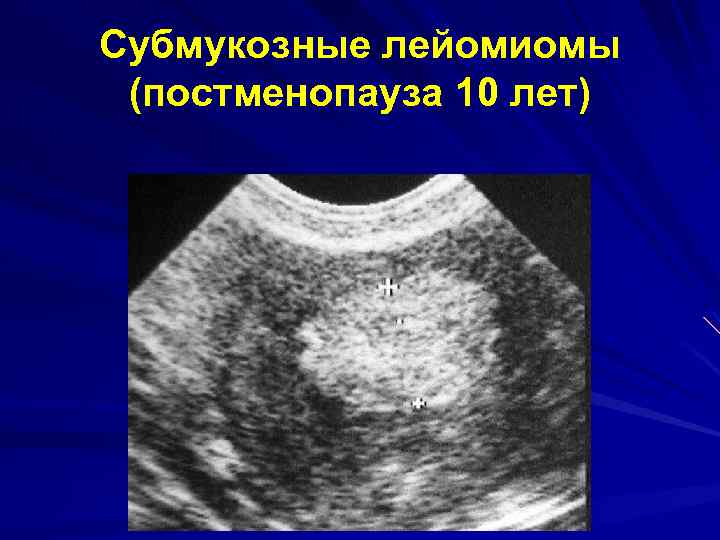Субмукозные лейомиомы (постменопауза 10 лет) 
